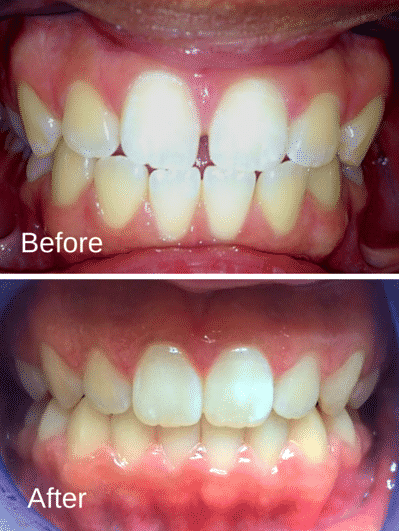 Patient1_BeforeAfter_Invisalign-e1441385145543