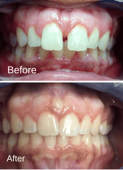 Patient2_BeforeAfter_Invisalign-e1441385208473