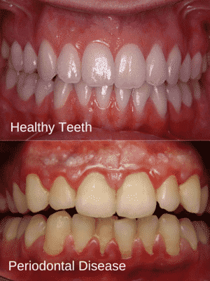 HealthyPeriodontal-teeth_duel_image-e1441994700654