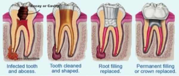 Root-Canal_progression-graphicenlarged-e1446742688982