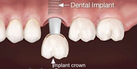 dental-implant-crown