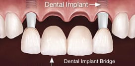dental-implant-supported-bridge