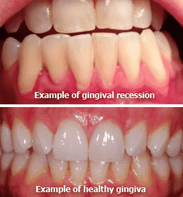 healthy-gumsrecessive-gums_duel_image
