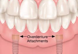 overdenture-dental-implants