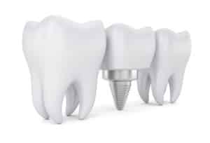 Do dental implants need to be replaced
