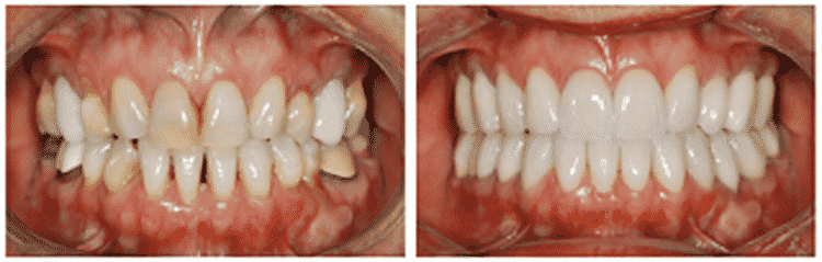 Smile Makeover