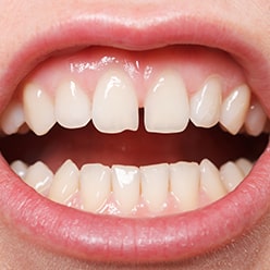 Decreasing The Gap Between Teeth