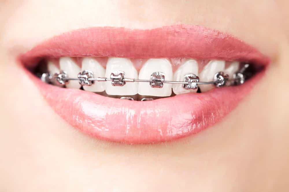 When is a Good Time to Start Considering Braces?