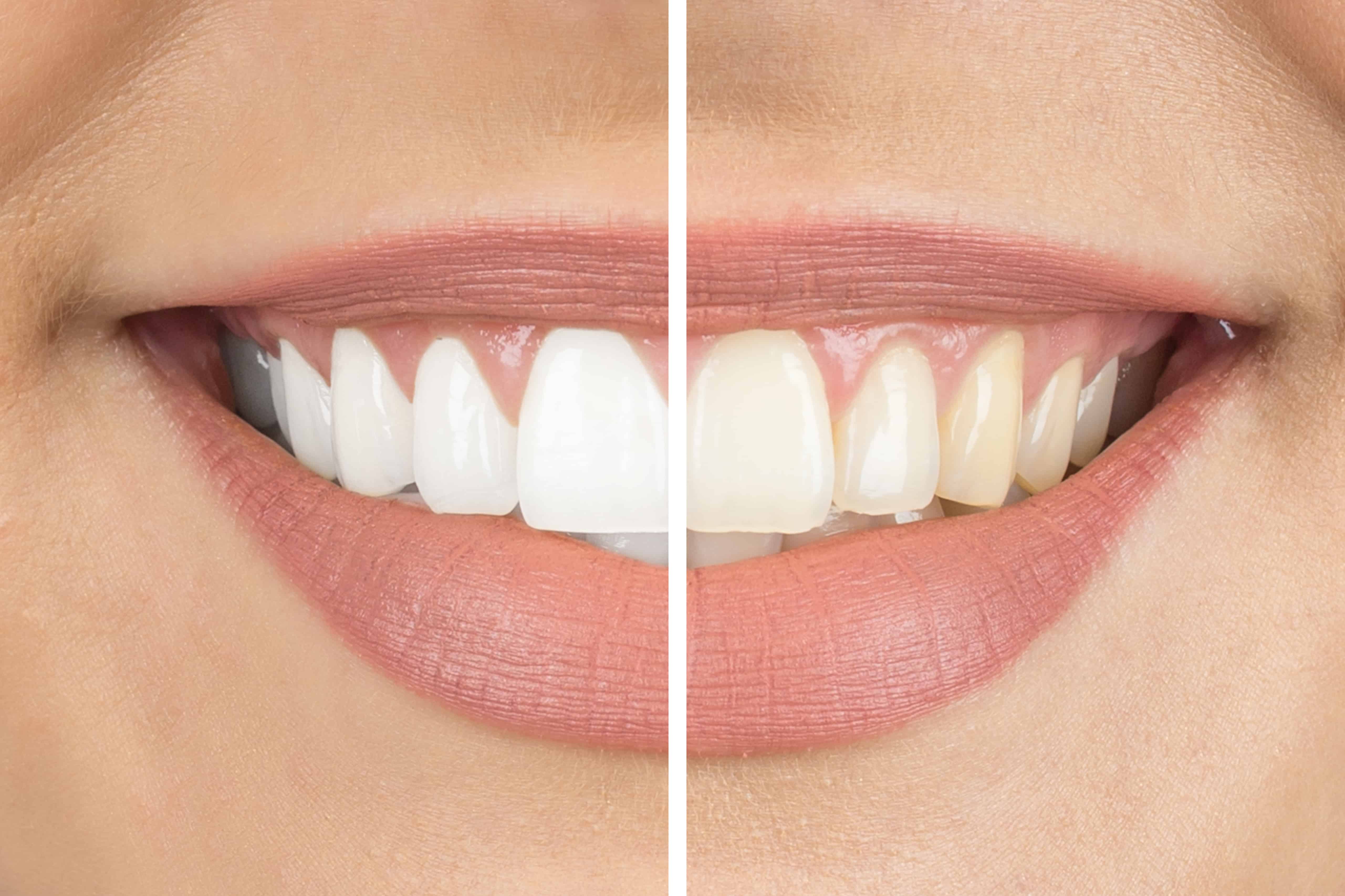 Considering Teeth Whitening? Extrinsic and Intrinsic Causes of Tooth Discoloration